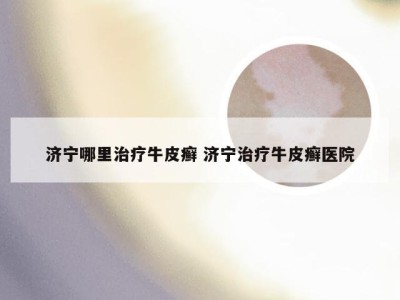 济宁哪里治疗牛皮癣 济宁治疗牛皮癣医院