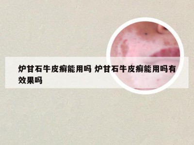 炉甘石牛皮癣能用吗 炉甘石牛皮癣能用吗有效果吗