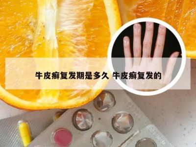 牛皮癣复发期是多久 牛皮癣复发的