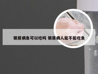 银屑病鱼可以吃吗 银屑病人能不能吃鱼