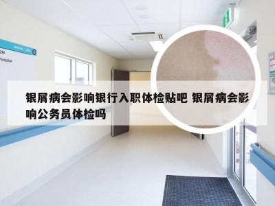 银屑病会影响银行入职体检贴吧 银屑病会影响公务员体检吗