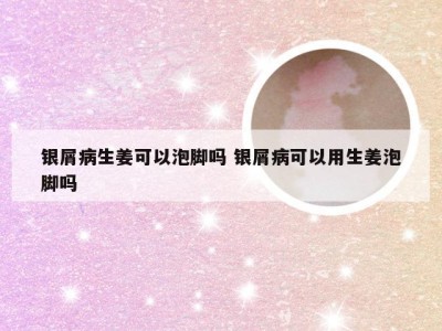 银屑病生姜可以泡脚吗 银屑病可以用生姜泡脚吗