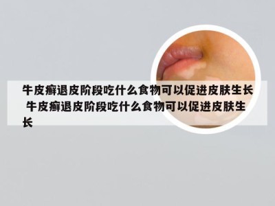 牛皮癣退皮阶段吃什么食物可以促进皮肤生长 牛皮癣退皮阶段吃什么食物可以促进皮肤生长