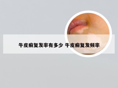 牛皮癣复发率有多少 牛皮癣复发频率