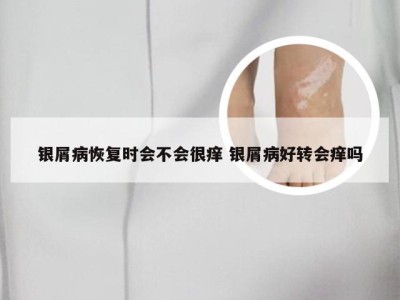 银屑病恢复时会不会很痒 银屑病好转会痒吗