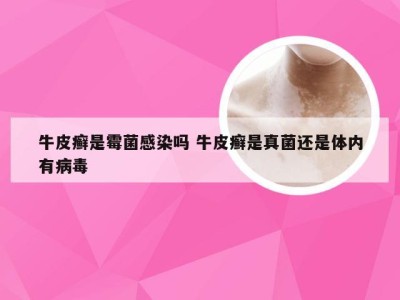 牛皮癣是霉菌感染吗 牛皮癣是真菌还是体内有病毒
