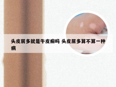 头皮屑多就是牛皮癣吗 头皮屑多算不算一种病