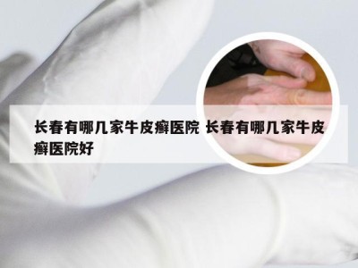 长春有哪几家牛皮癣医院 长春有哪几家牛皮癣医院好