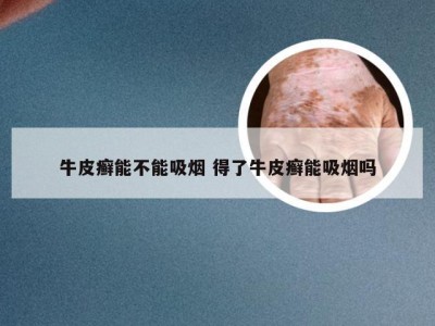 牛皮癣能不能吸烟 得了牛皮癣能吸烟吗