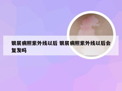 银屑病照紫外线以后 银屑病照紫外线以后会复发吗