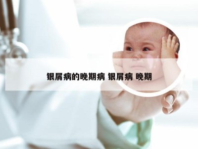 银屑病的晚期病 银屑病 晚期