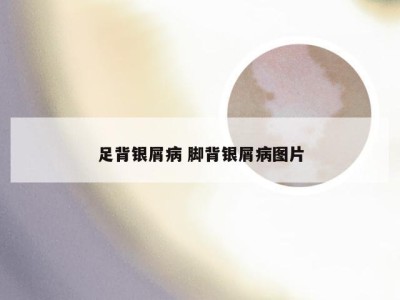 足背银屑病 脚背银屑病图片