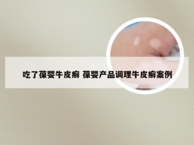 吃了葆婴牛皮癣 葆婴产品调理牛皮癣案例