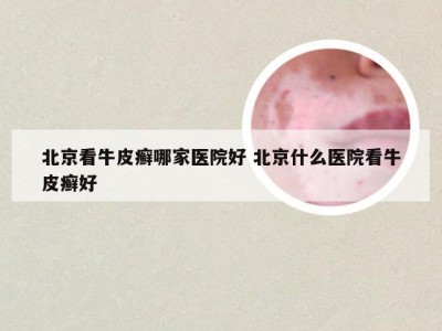 北京看牛皮癣哪家医院好 北京什么医院看牛皮癣好