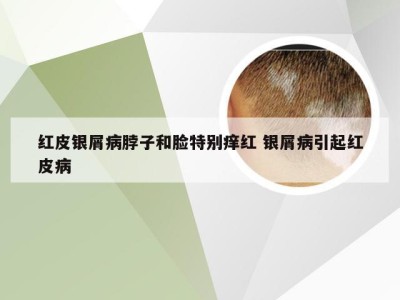红皮银屑病脖子和脸特别痒红 银屑病引起红皮病