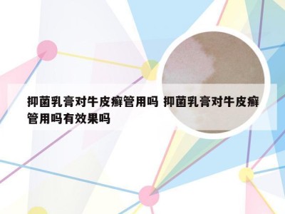 抑菌乳膏对牛皮癣管用吗 抑菌乳膏对牛皮癣管用吗有效果吗