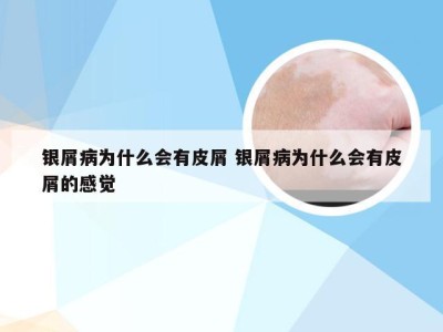 银屑病为什么会有皮屑 银屑病为什么会有皮屑的感觉
