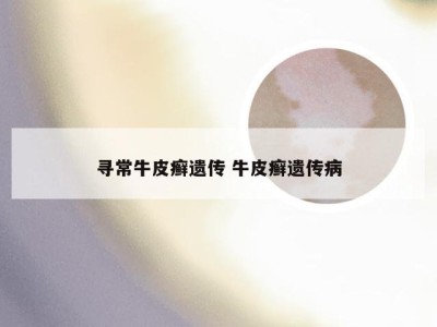 寻常牛皮癣遗传 牛皮癣遗传病