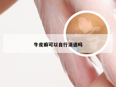 牛皮癣可以自行消退吗