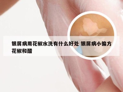 银屑病用花椒水洗有什么好处 银屑病小偏方花椒和醋