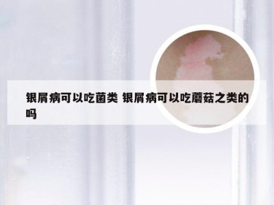 银屑病可以吃菌类 银屑病可以吃蘑菇之类的吗