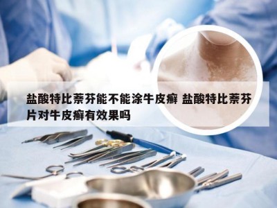 盐酸特比萘芬能不能涂牛皮癣 盐酸特比萘芬片对牛皮癣有效果吗