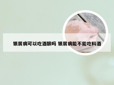 银屑病可以吃酒酿吗 银屑病能不能吃料酒