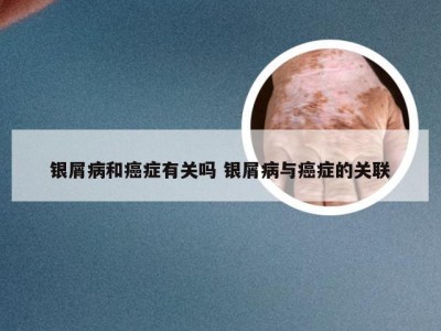 银屑病和癌症有关吗 银屑病与癌症的关联