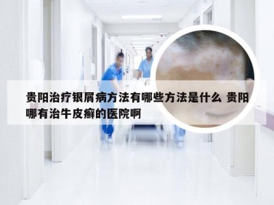 贵阳治疗银屑病方法有哪些方法是什么 贵阳哪有治牛皮癣的医院啊
