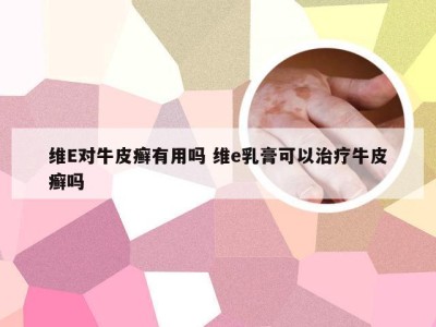 维E对牛皮癣有用吗 维e乳膏可以治疗牛皮癣吗