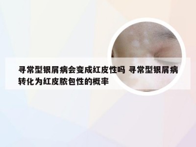 寻常型银屑病会变成红皮性吗 寻常型银屑病转化为红皮脓包性的概率