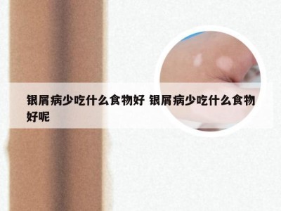 银屑病少吃什么食物好 银屑病少吃什么食物好呢