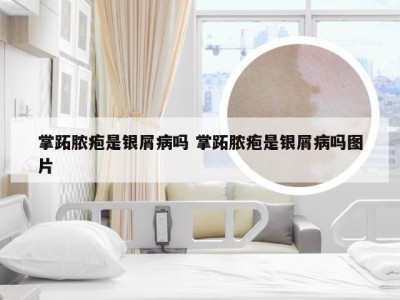 掌跖脓疱是银屑病吗 掌跖脓疱是银屑病吗图片
