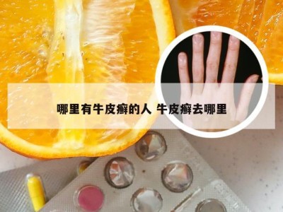 哪里有牛皮癣的人 牛皮癣去哪里
