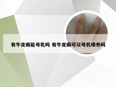 有牛皮癣能母乳吗 有牛皮癣可以母乳喂养吗