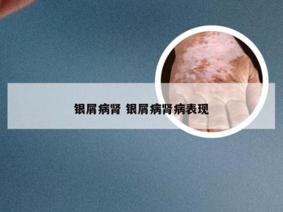 银屑病肾 银屑病肾病表现