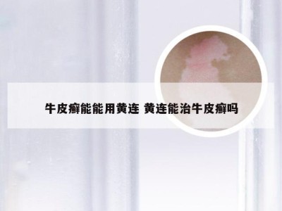 牛皮癣能能用黄连 黄连能治牛皮癣吗