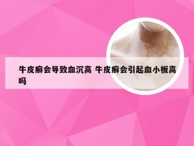 牛皮癣会导致血沉高 牛皮癣会引起血小板高吗
