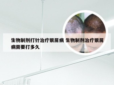 生物制剂打针治疗银屑病 生物制剂治疗银屑病需要打多久