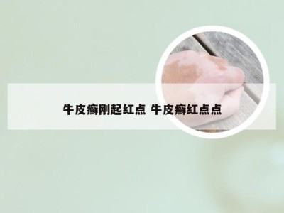 牛皮癣刚起红点 牛皮癣红点点