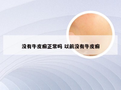 没有牛皮癣正常吗 以前没有牛皮癣