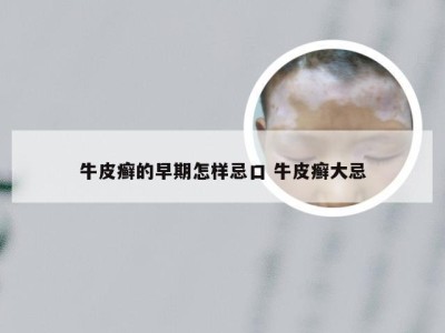 牛皮癣的早期怎样忌口 牛皮癣大忌