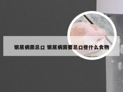 银屑病需忌口 银屑病需要忌口些什么食物