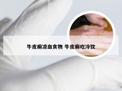 牛皮癣凉血食物 牛皮癣吃冷饮