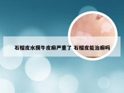 石榴皮水摸牛皮癣严重了 石榴皮能治癣吗