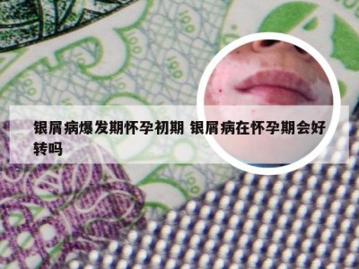 银屑病爆发期怀孕初期 银屑病在怀孕期会好转吗