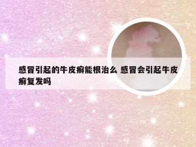 感冒引起的牛皮癣能根治么 感冒会引起牛皮癣复发吗
