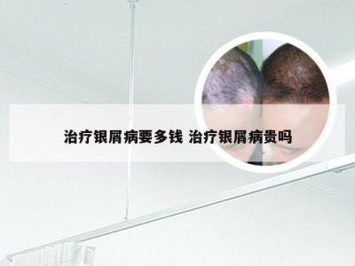 治疗银屑病要多钱 治疗银屑病贵吗