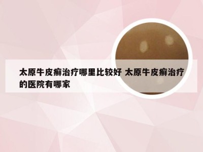 太原牛皮癣治疗哪里比较好 太原牛皮癣治疗的医院有哪家