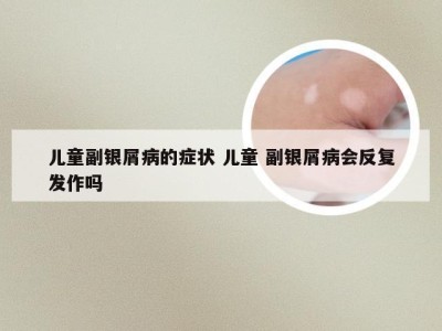 儿童副银屑病的症状 儿童 副银屑病会反复发作吗